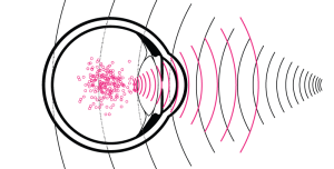 A diagram of an eyeball with overlapping pink and black waves