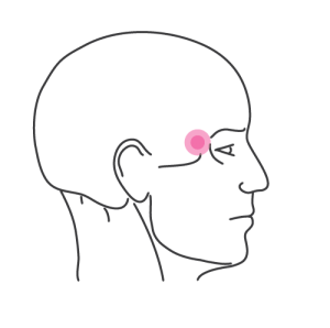 A drawn diagram of a side view of a man's head. A pink coloured circle marks the temple area.